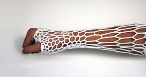 un-etudiant-invente-un-platre-revolutionnaire-qui-respire-grace-a-une-imprimante-3d-une