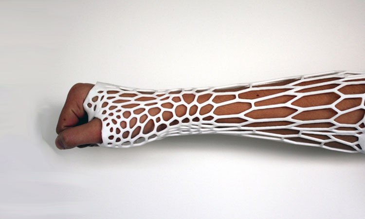 un-etudiant-invente-un-platre-revolutionnaire-qui-respire-grace-a-une-imprimante-3d-une