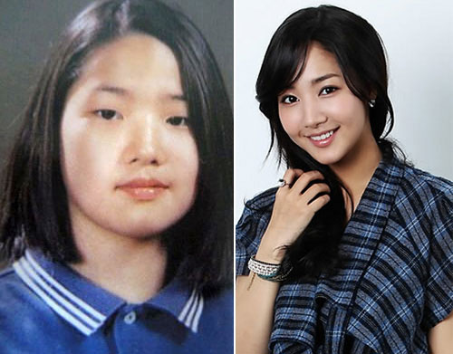 avantapres-31-photos-completement-folles-de-chirurgie-esthetique-en-coree-du-sud25