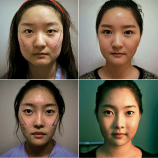 avantapres-31-photos-completement-folles-de-chirurgie-esthetique-en-coree-du-sud30