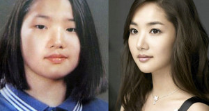 avantapres-31-photos-completement-folles-de-chirurgie-esthetique-en-coree-du-sudUne