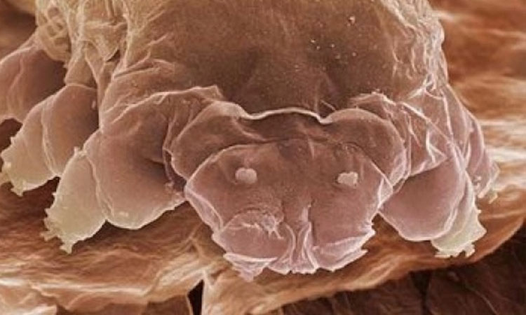 demodex-folliculorum-lacarien-rampant-qui-infeste-votre-visage-et-dont-les-excrements-provoqueraient-la-couperose-une