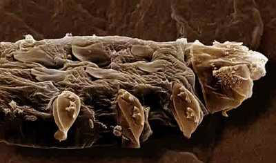 voici-le-demodex-folliculorum-un-minuscule-acarien-responsable-d-une-vilaine-maladie-de-la-peau4