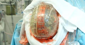 premiere-mondiale-des-chirurgiens-ont-implante-un-crane-entierement-fabrique-par-une-imprimante-3dune