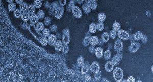 cancer-guerison-virus-rougeole-une