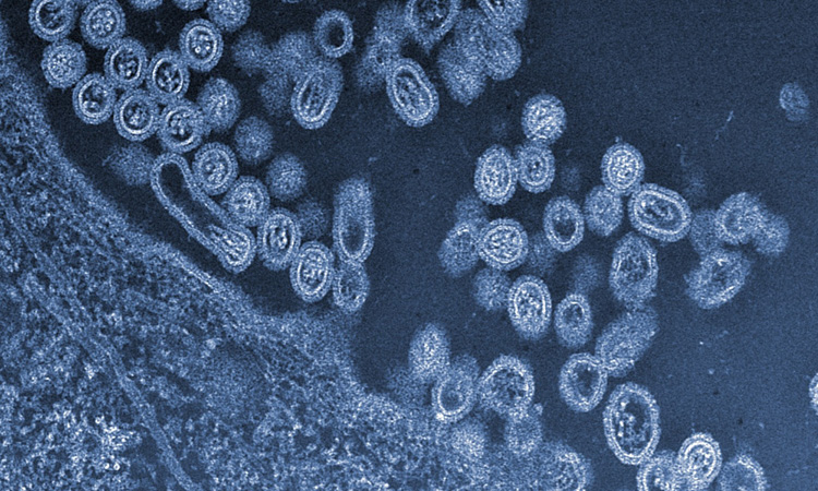 cancer-guerison-virus-rougeole-une