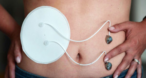 diabiete-pancreas-bio-artificiel-sante