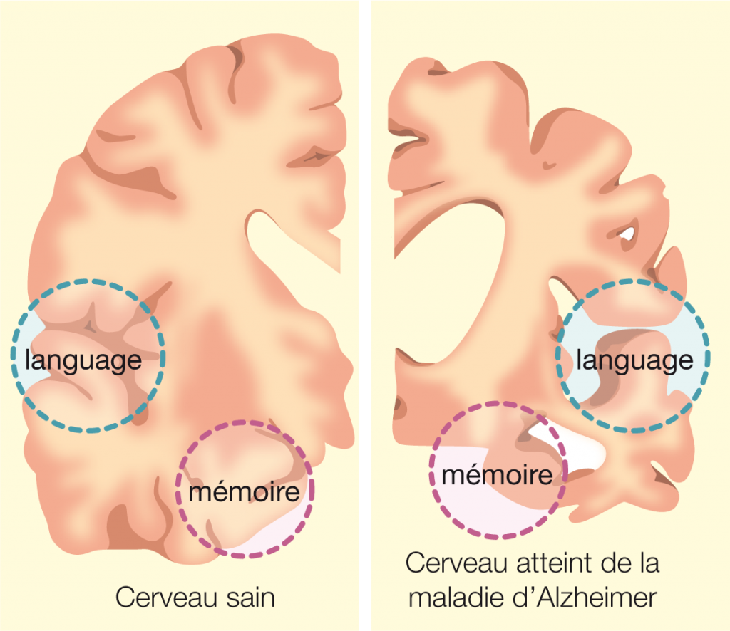 comparaison-cerveau-sain-et-malade-alzheimer