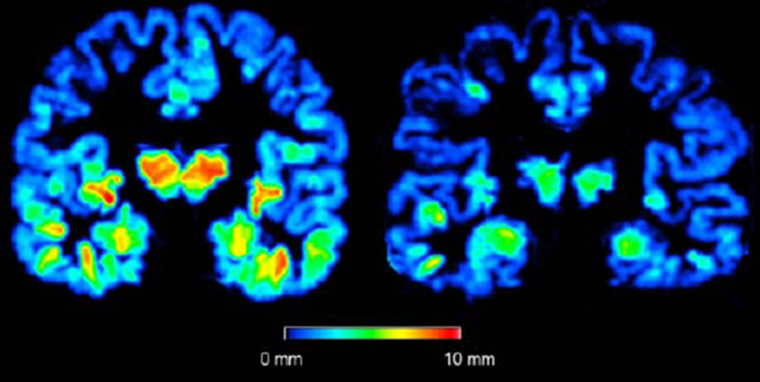 rétrecissement-du-cerveau
