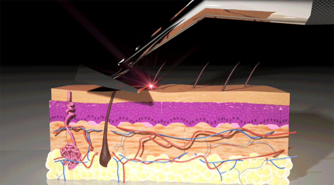 04-laser-skarptechnologies