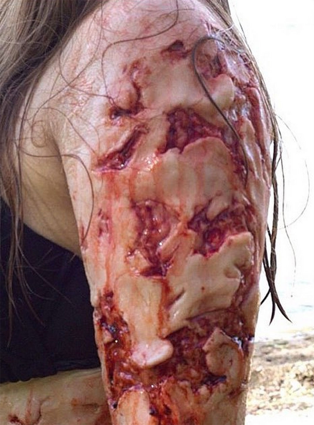 24-brasblesse-bethanyroseleblanc