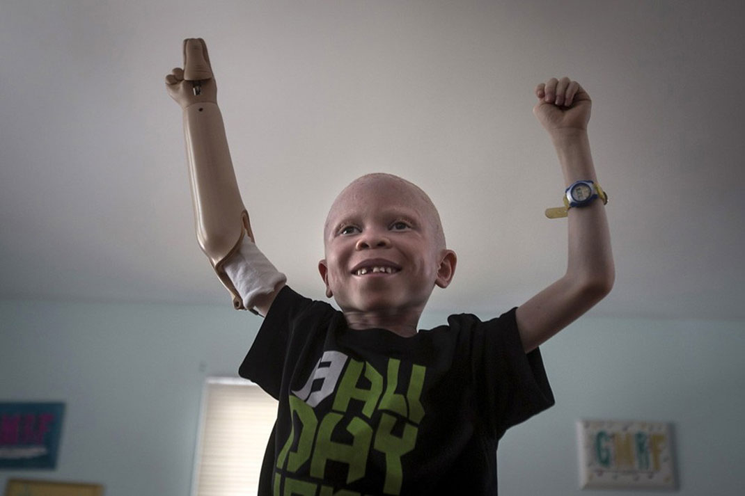 03-enfantalbinos-carloallegrireuters