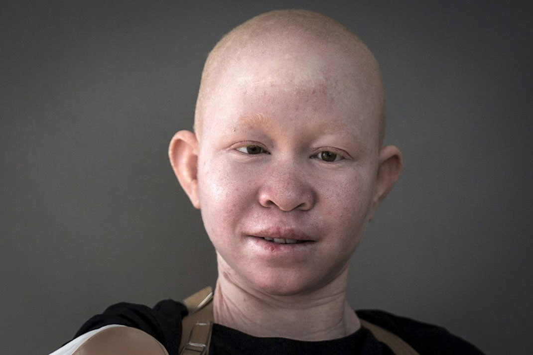 07-enfantalbinos-carloallegrireuters