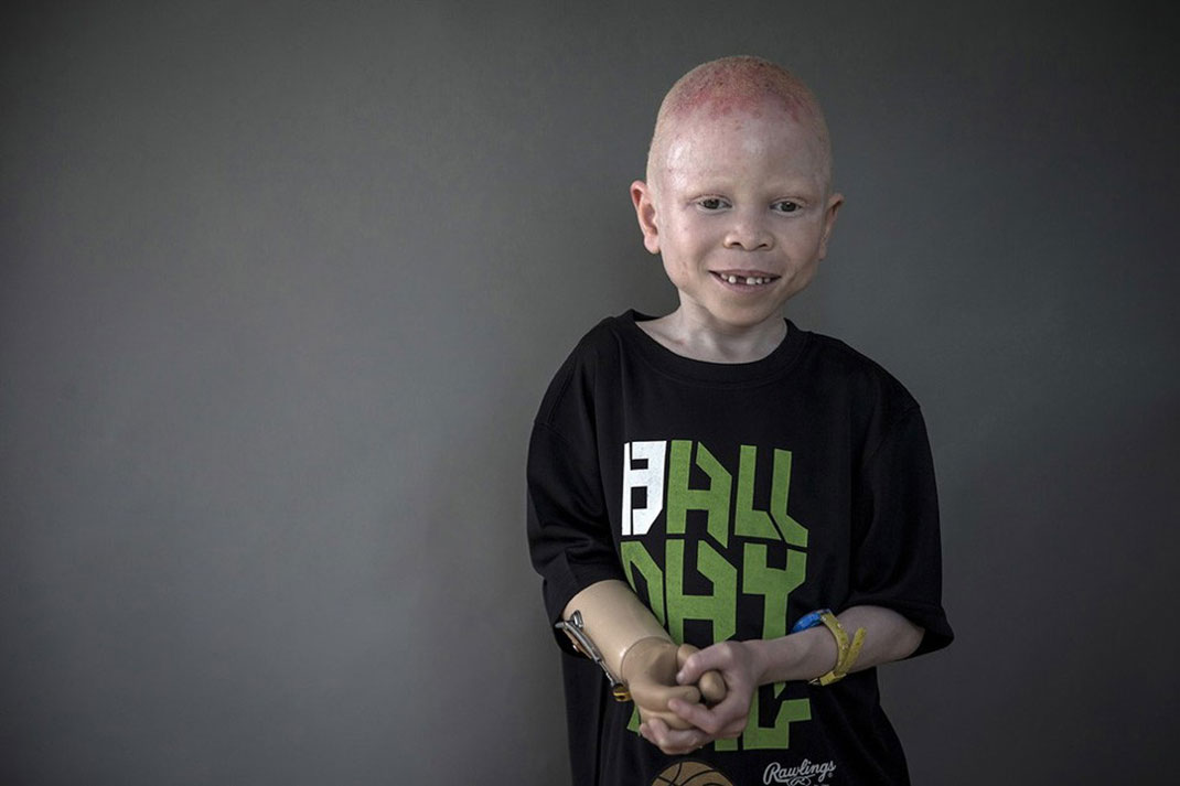 12-enfantalbinos-carloallegrireuters