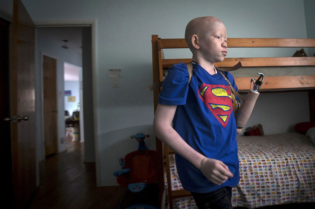 13-enfantalbinos-carloallegrireuters