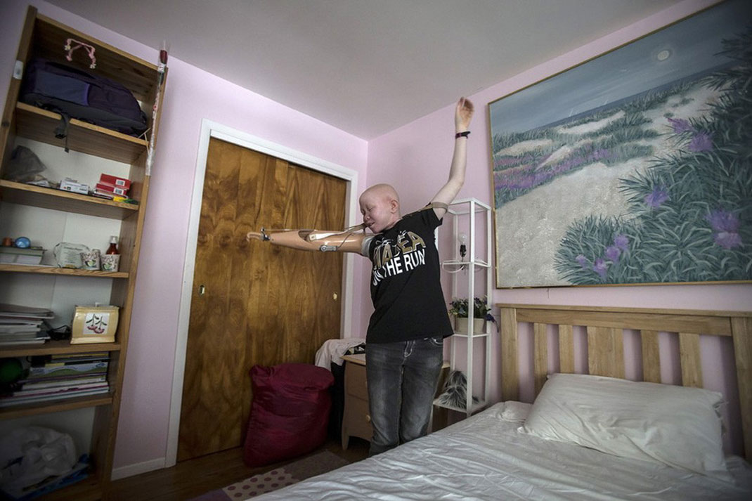 15-enfantalbinos-carloallegrireuters