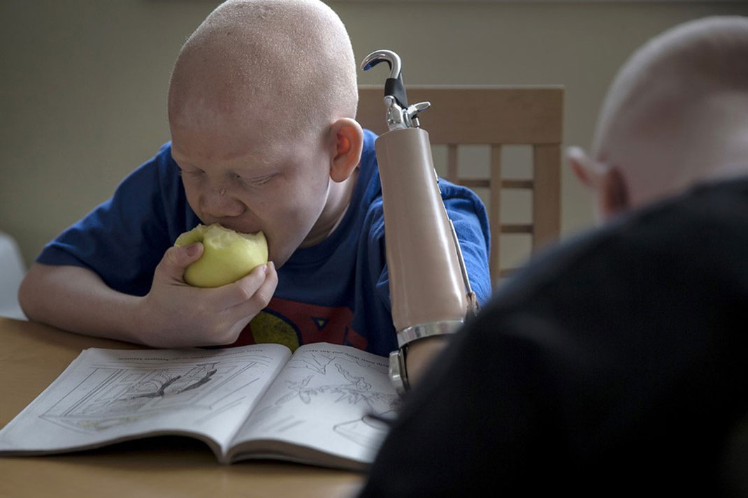 19-enfantalbinos-carloallegrireuters