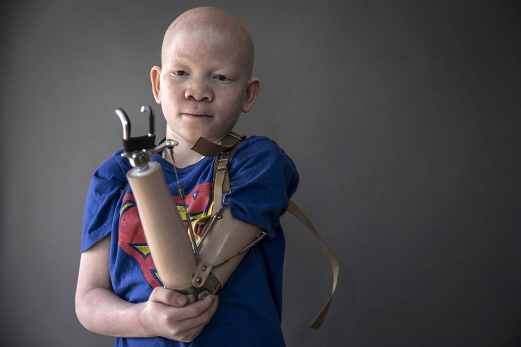 20-enfantalbinos-carloallegrireuters