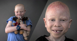 une-albinos3