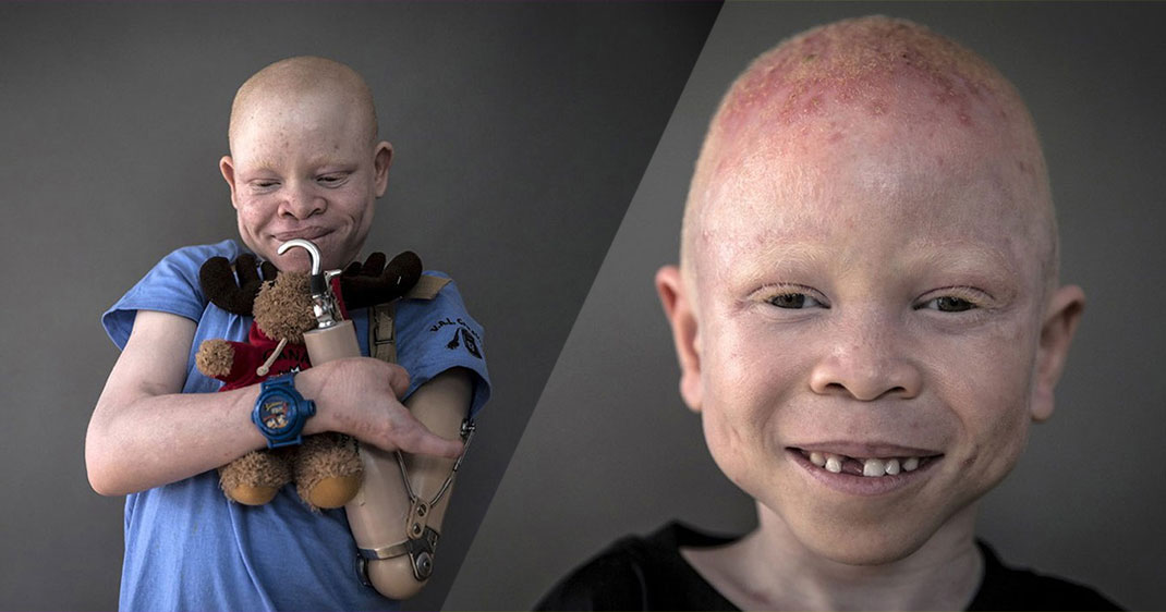 une-albinos3