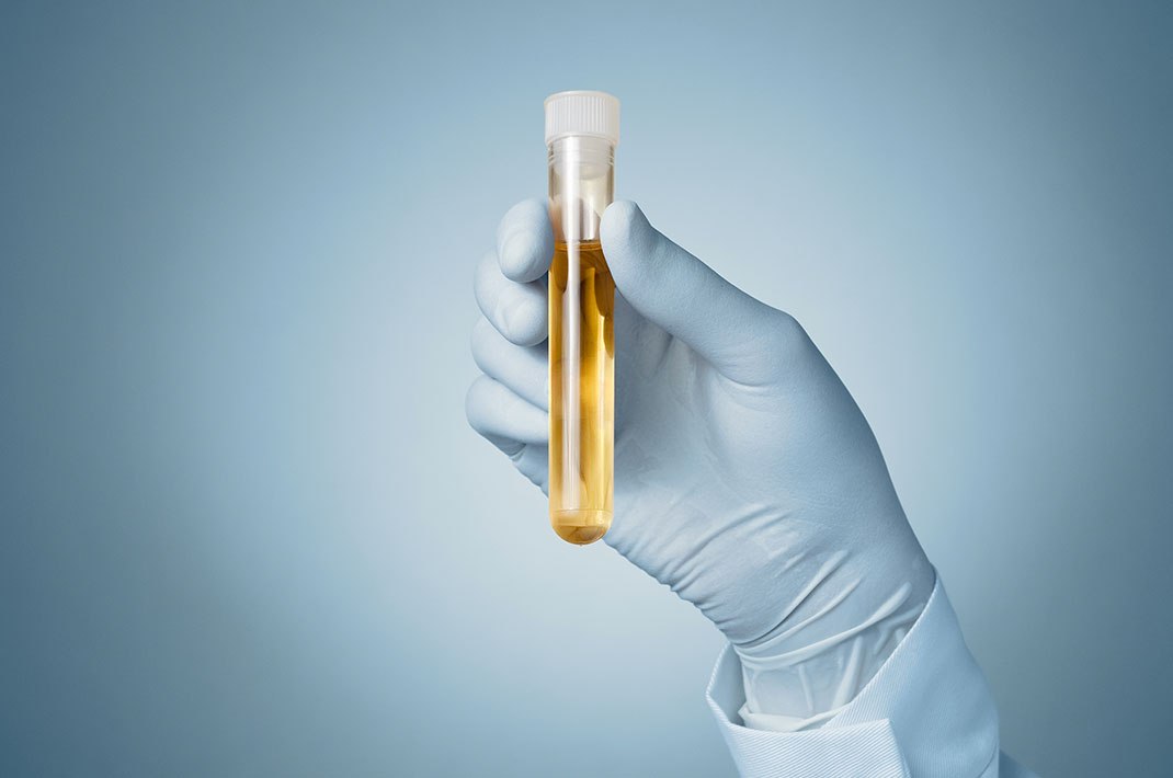 De l'urine via Shutterstock